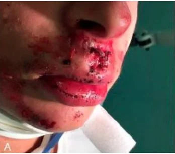 Facial Injury: 3-Month Photo Follow-Up