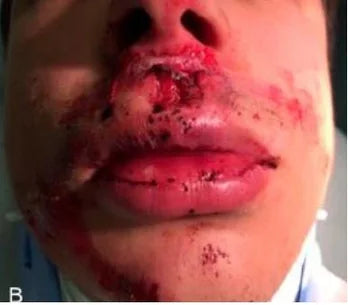 Facial Injury: 3-Month Photo Follow-Up