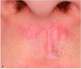 Facial Injury: 3-Month Photo Follow-Up