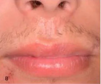 Facial Injury: 3-Month Photo Follow-Up