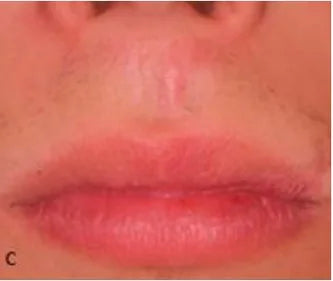 Facial Injury: 3-Month Photo Follow-Up
