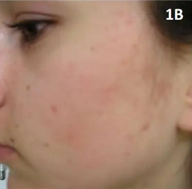 Red Pimples and Facial Redness