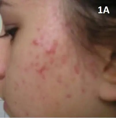 Red Pimples and Facial Redness