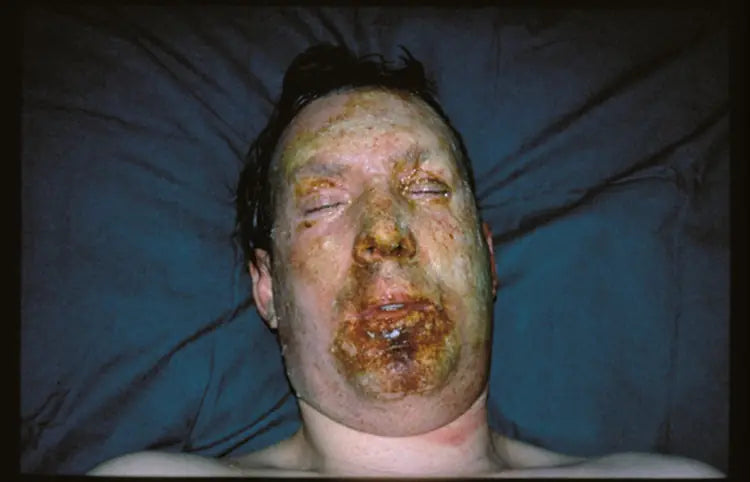 Flame Burn on Face: 12-Month Follow-Up