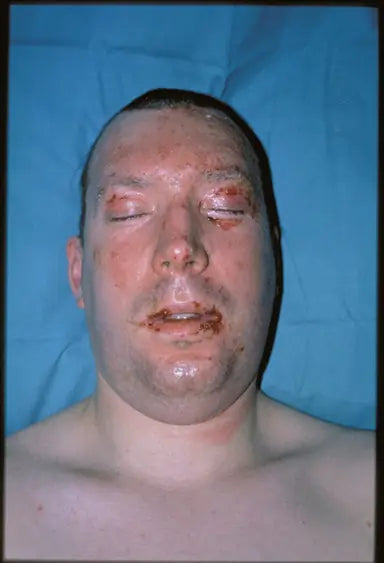 Flame Burn on Face: 12-Month Follow-Up