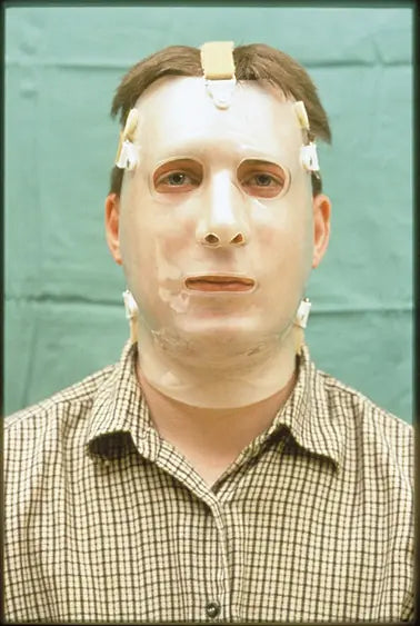 Flame Burn on Face: 12-Month Follow-Up