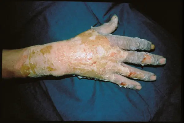 Flame Burn on Hand: 14-Month Follow-Up