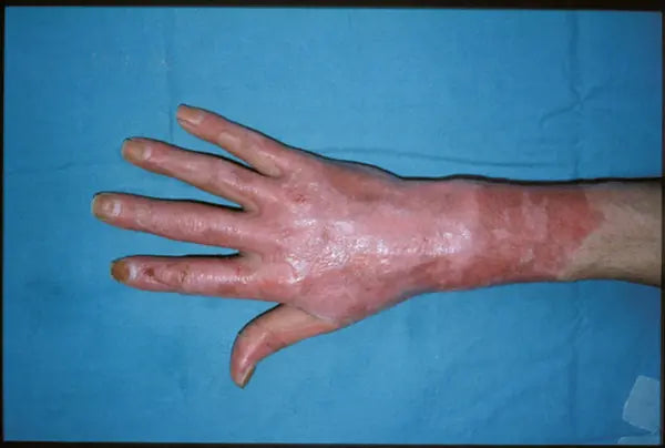 Flame Burn on Hand: 14-Month Follow-Up