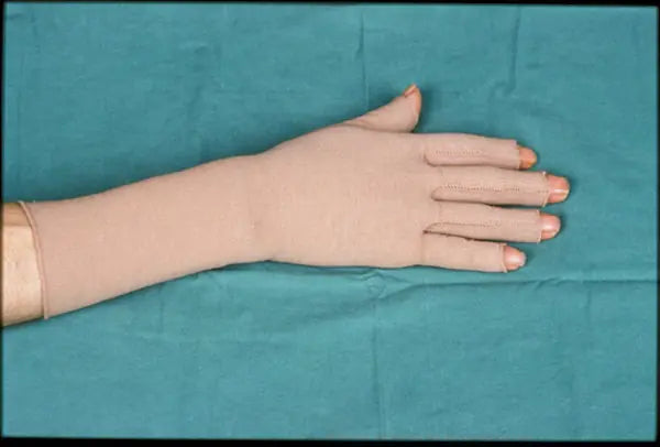 Flame Burn on Hand: 14-Month Follow-Up