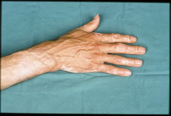 Flame Burn on Hand: 14-Month Follow-Up