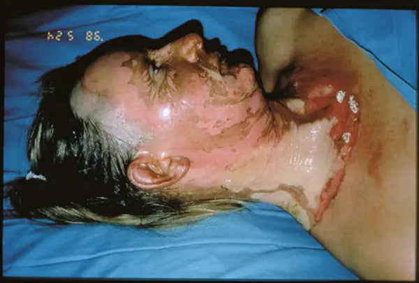 Flame Burn on Neck: 12-Month Follow-Up