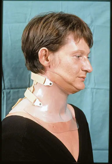 Flame Burn on Neck: 12-Month Follow-Up