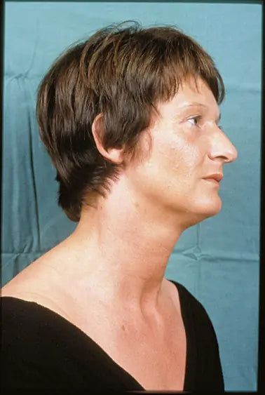 Flame Burn on Neck: 12-Month Follow-Up