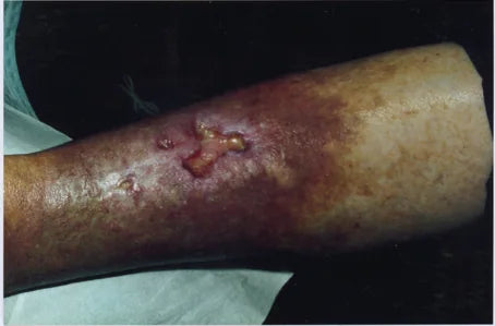 Grenade Wound: 6-Month Photos