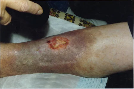 Grenade Wound: 6-Month Photos