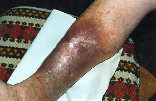 Grenade Wound: 6-Month Photos