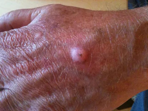 Skin Bump on Back of Hand: Photo Series