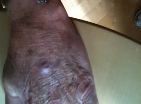 Skin Bump on Back of Hand: Photo Series