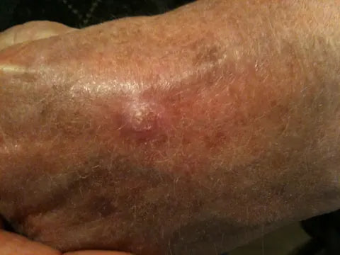 Skin Bump on Back of Hand: Photo Series