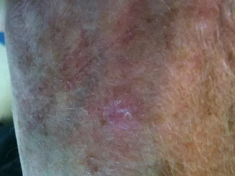 Skin Bump on Back of Hand: Photo Series