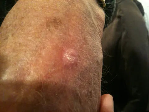 Skin Bump on Back of Hand: Photo Series