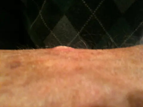 Skin Bump on Back of Hand: Photo Series