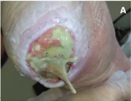 Severe Heel Bedsore: 67-Day Photo Series