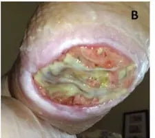 Severe Heel Bedsore: 67-Day Photo Series