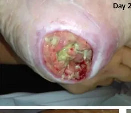 Severe Heel Bedsore: 67-Day Photo Series