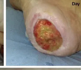 Severe Heel Bedsore: 67-Day Photo Series