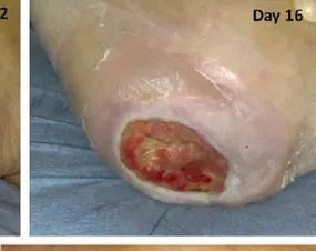 Severe Heel Bedsore: 67-Day Photo Series