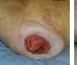 Severe Heel Bedsore: 67-Day Photo Series