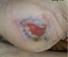 Severe Heel Bedsore: 67-Day Photo Series