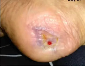 Severe Heel Bedsore: 67-Day Photo Series