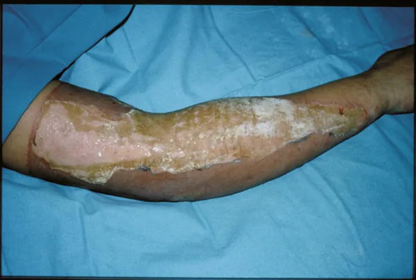 Hot Water Arm Burn: 12-Month Follow-Up
