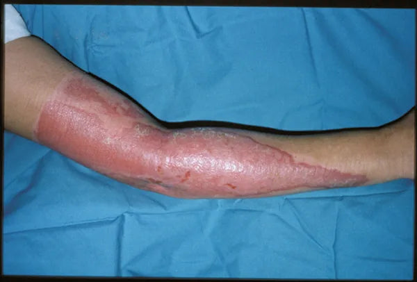 Hot Water Arm Burn: 12-Month Follow-Up