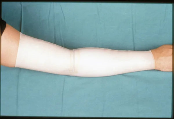 Hot Water Arm Burn: 12-Month Follow-Up