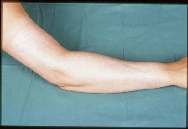 Hot Water Arm Burn: 12-Month Follow-Up