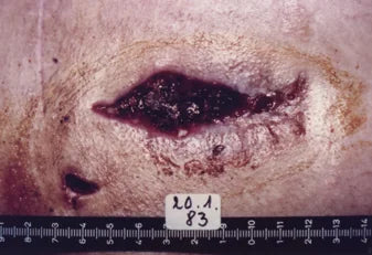 Infected Stab Wound: Photo Series