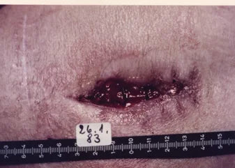Infected Stab Wound: Photo Series