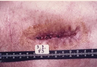 Infected Stab Wound: Photo Series