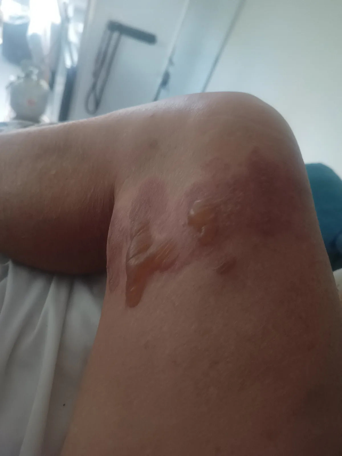 Jennifer’s Knee Burn: Photo Series