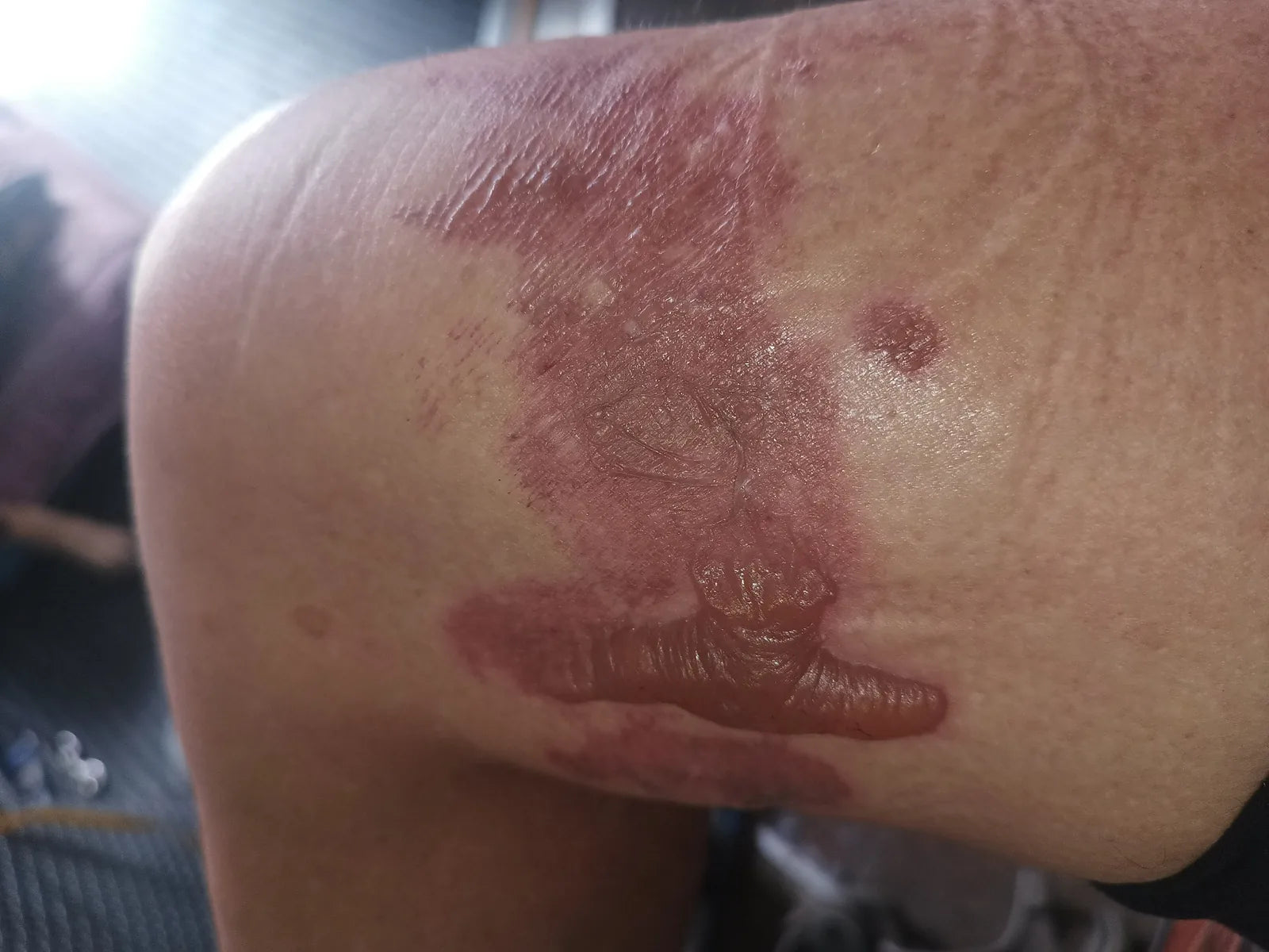 Jennifer’s Knee Burn: Photo Series