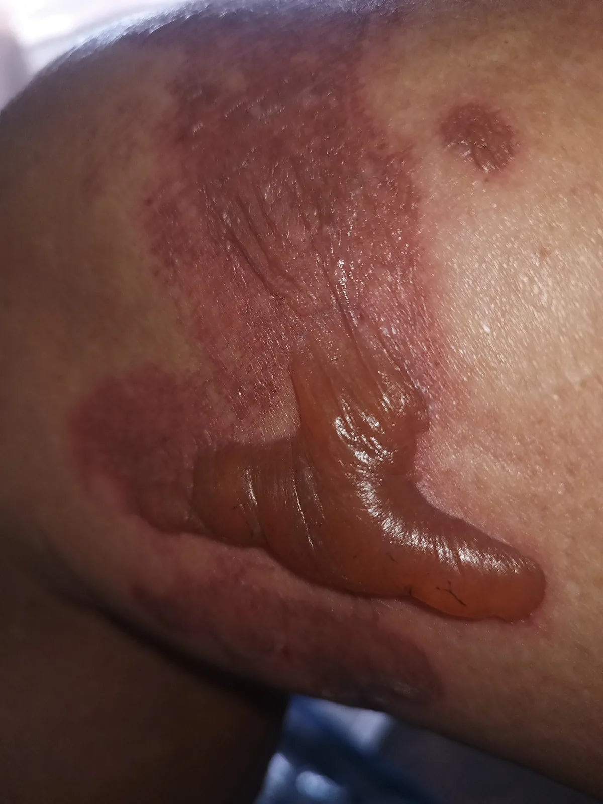 Jennifer’s Knee Burn: Photo Series