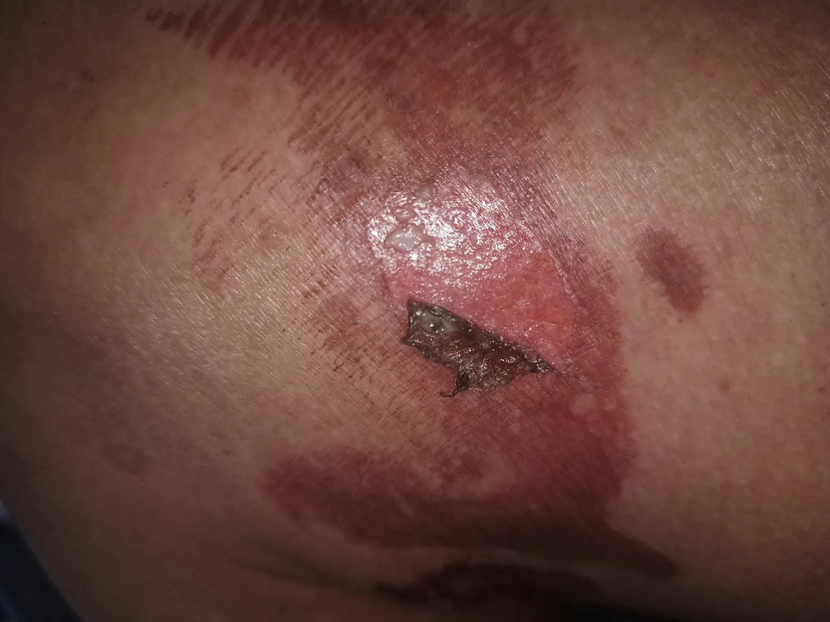 Jennifer’s Knee Burn: Photo Series