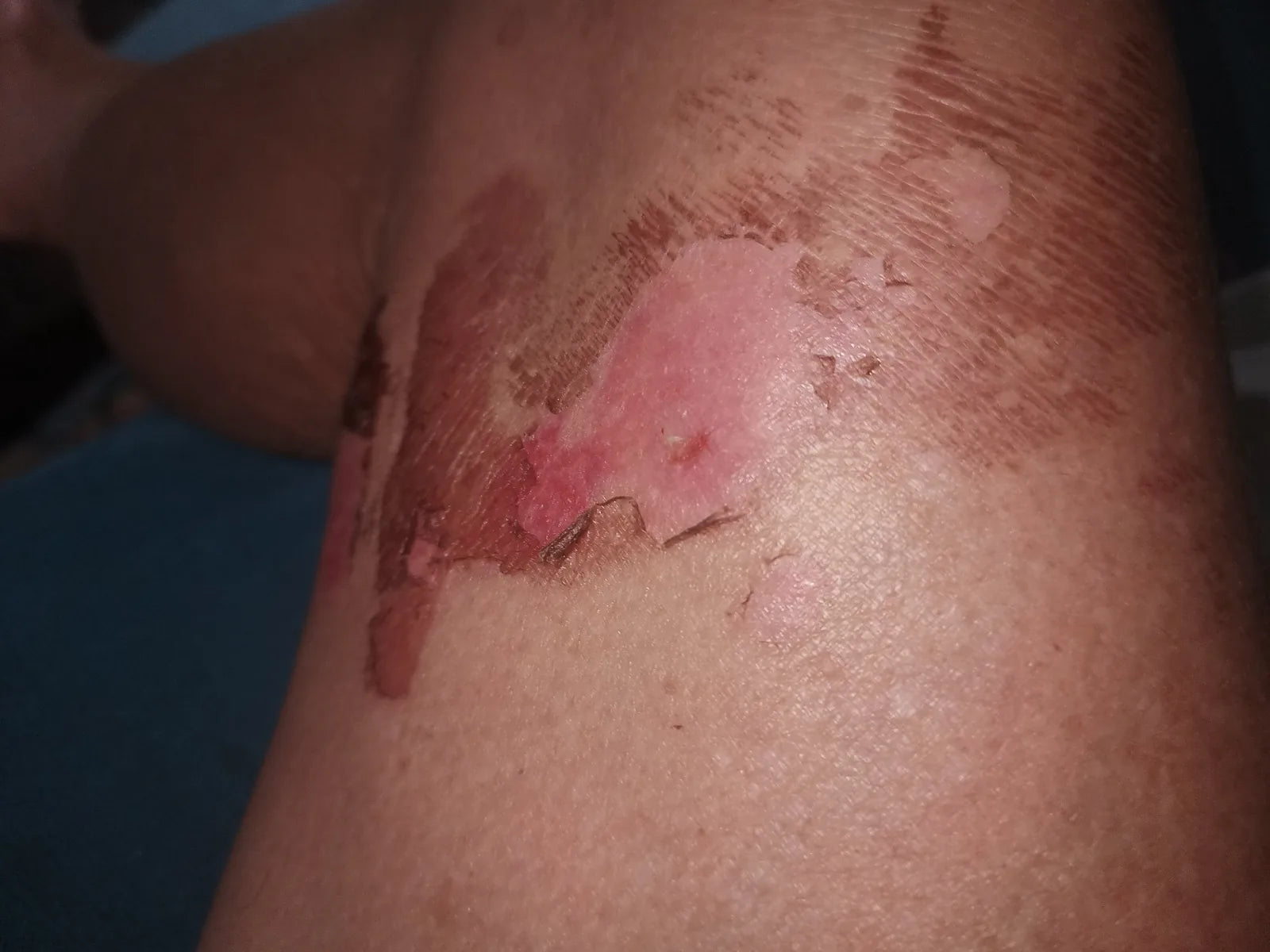 Jennifer’s Knee Burn: Photo Series