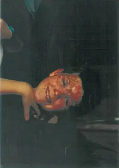 Jess: Severe Face, Hand and Leg Burns
