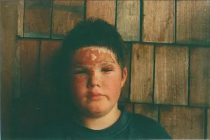 Jess: Severe Face, Hand and Leg Burns