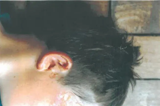 Jess: Severe Face, Hand and Leg Burns