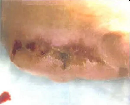 John Casey's Diabetic Foot Wound Recovery
